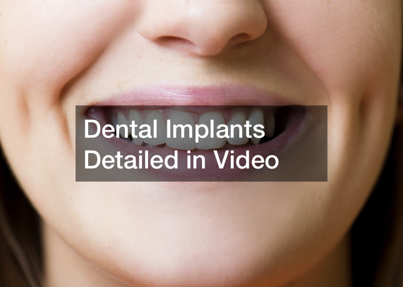 Dental Implants Detailed in Video