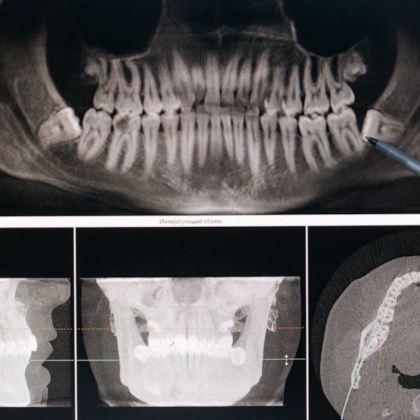 dental X-rays