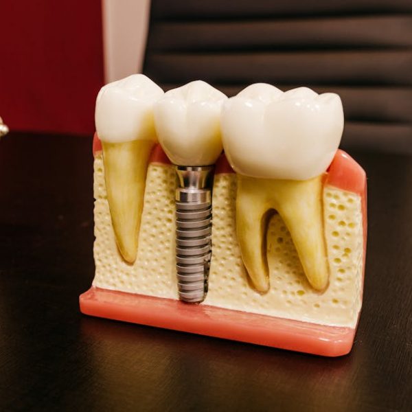 dental implant