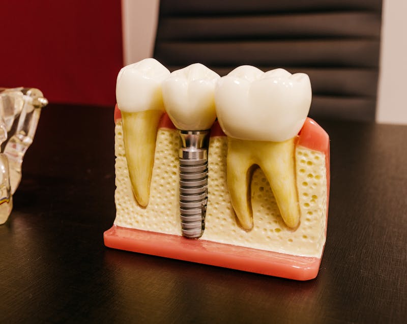 dental implant